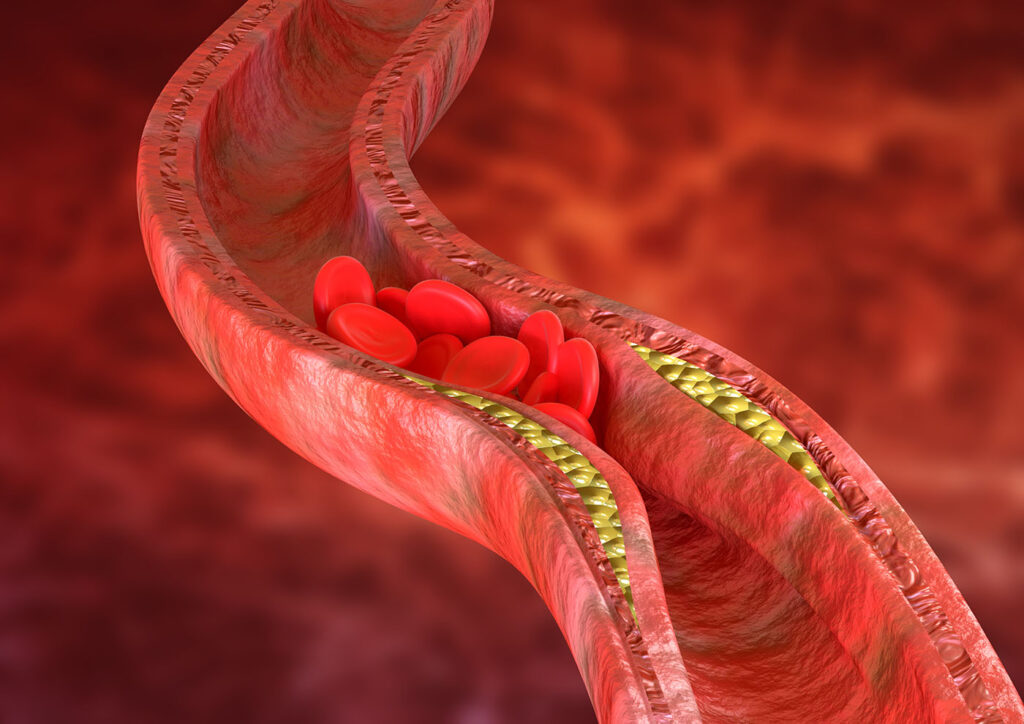 O que é Angioplastia Coronariana